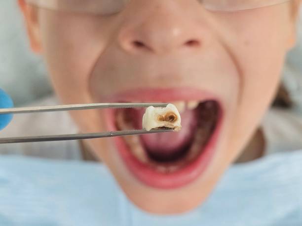 Best Emergency Tooth Extraction in Colfax, WA