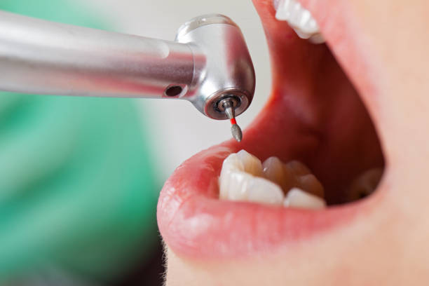 Best Emergency Wisdom Teeth Removal in Colfax, WA